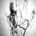 Science Art: <i>Angiome Annulaire</i>, by Dr. Michel Royon Science Art: <i>Angiome Annulaire</i>, by Dr. Michel Royon