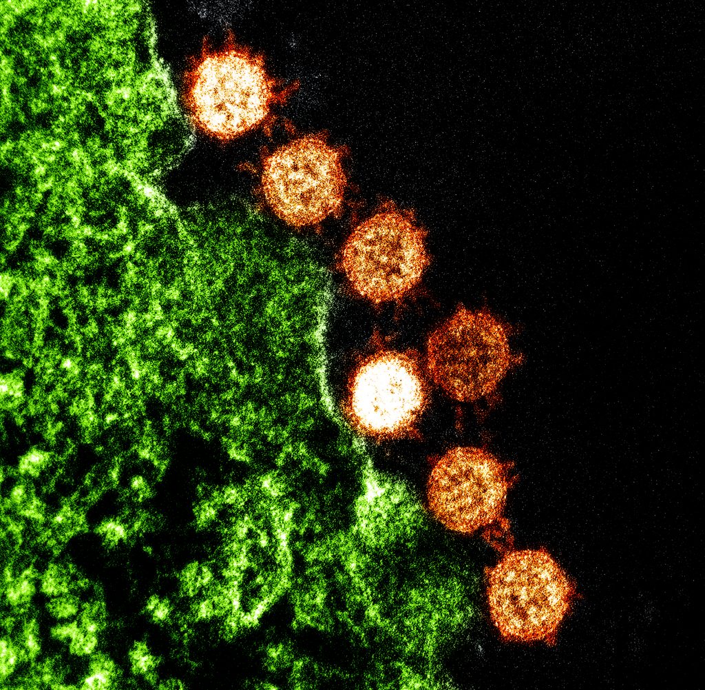Scientific illustration of SARS virus particles, a kind of coronavirus