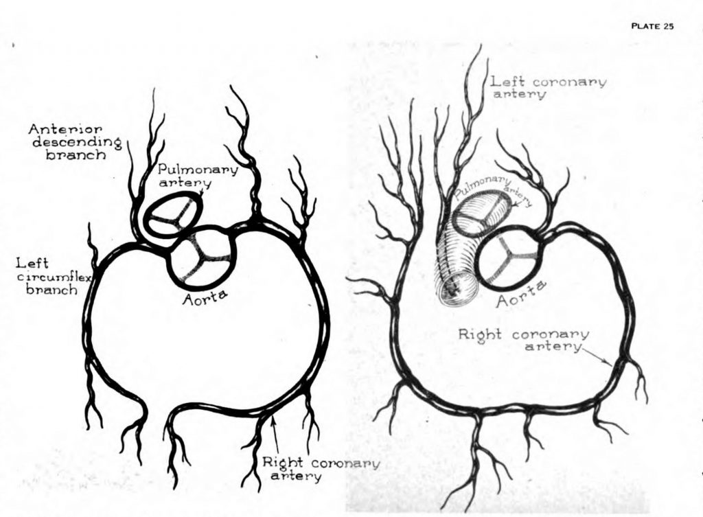 Scientific illustration of the arteries leading into the heart, one normal and one abnormal