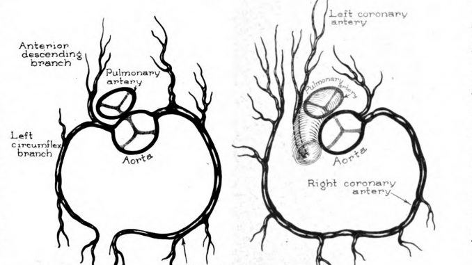 Scientific illustration of the arteries leading into the heart, one normal and one abnormal