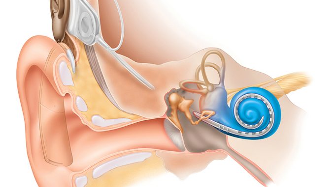 Scientific illustration of a cochlear implant; a bionic ear.