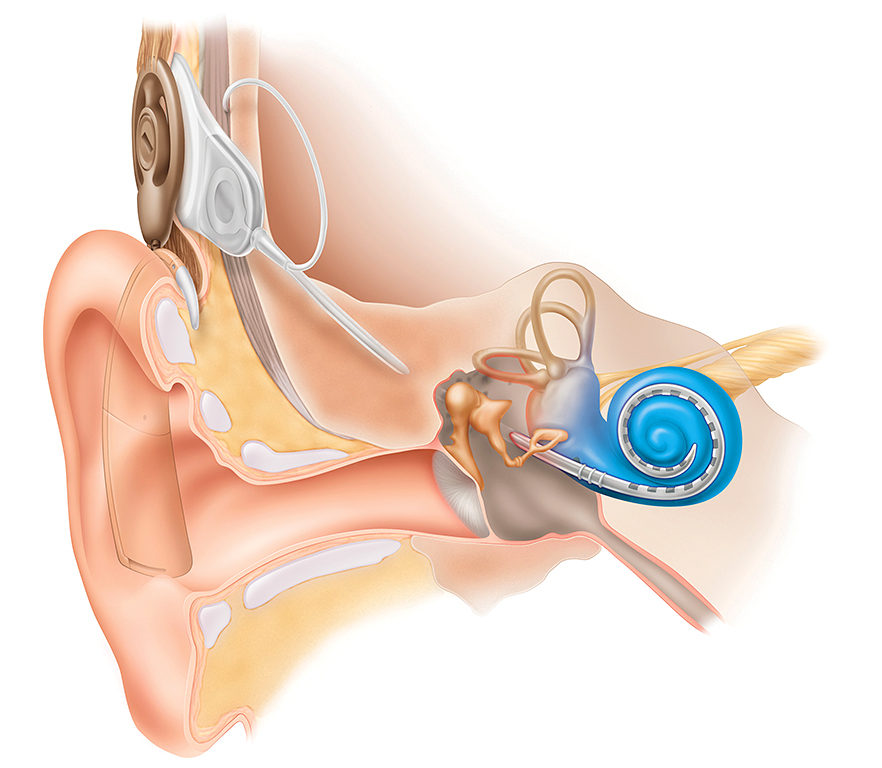 Scientific illustration of a cochlear implant; a bionic ear.