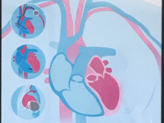 Scientific illustration of pacemakers, defibrillators, monitors, loop recorders, and other electronic devices inserted into the anatomically correct hearts.