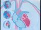Scientific illustration of pacemakers, defibrillators, monitors, loop recorders, and other electronic devices inserted into the anatomically correct hearts.