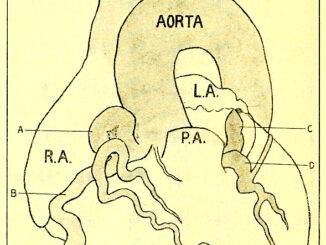 Scientific illustration of a heart with several kinds of aneurysms in the vessels surrounding the muscle.