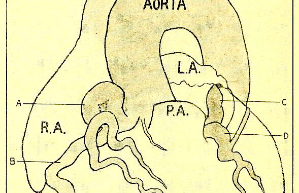 Scientific illustration of a heart with several kinds of aneurysms in the vessels surrounding the muscle.