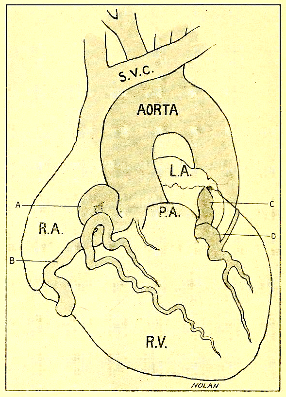 Scientific illustration of a heart with several kinds of aneurysms in the vessels surrounding the muscle.